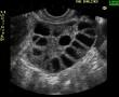 A PCOS (Polycystic Ovary Syndrome) 