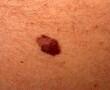 Melanoma Melanoma