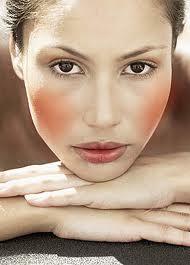 rosacea, rosaceás bőr, rosacea, rosaceás bőr,