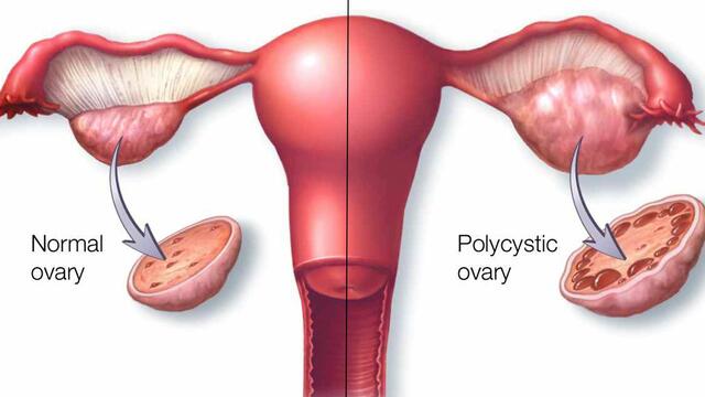 Policisztás ovárium szindróma - PCOS 