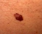 Melanoma Melanoma