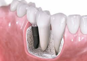 fogpótlás, implantáció fogpótlás, implantáció