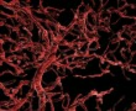 A cukorbetegség szövődményei - felgyorsult érelmeszesedés A cukorbetegség szövődményei - felgyorsult érelmeszesedés