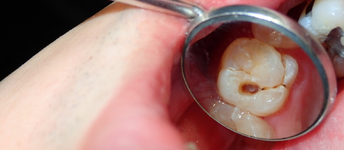 A cukortól valóban kihullhat a fogunk?