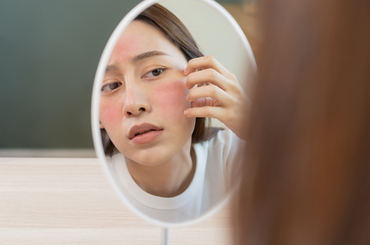 Miért ég az arcom? – 5 ok, amiért érzékeny bőröd kipirosodhat