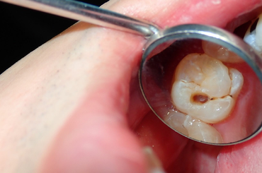 A cukortól valóban kihullhat a fogunk?